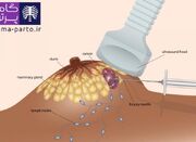 آیا سرطان سینه با سونوگرافی قابل مشاهده است؟ - اکونیوز