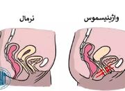 روش های بهبود قطعی واژینیسموس یا عدم دخول - اکونیوز