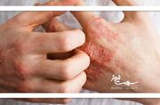 اگزما با این راهکارها درمان می‌شود - اکونیوز
