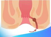 آیا فیستول مقعدی خطرناکه؟ - اکونیوز