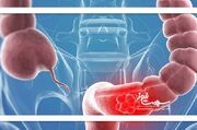 عوامل موثر در بروز سرطان روده / تغییر اجابت مزاج را جدی بگیر... -