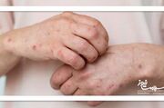 مشکلات پوستی که خبر از بیماری داخلی می‌دهند - اکونیوز