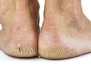 برای ترک پا چی خوبه؟ روشهای پیشگیری و رفع ترک پا - اکونیوز