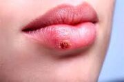 چرا تبخال با استرس تشدید می‌شود؟ / این چند راهکار ساده را انجام دهید