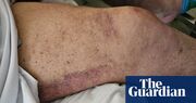 Perth man treated for scurvy as cost-of-living crisis brings back ‘disease of the past’