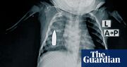 X-rays show shrapnel and bullets buried in children caught in Sudan war