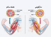 سارکوپنیا و ریزش عضله در سالمندی بخش اول