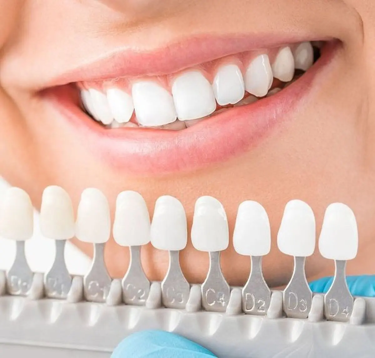 بلیچینگ دندان؛ مرز بین زیبایی و سلامت