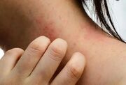 درباره جوش های پوستی و انواع آنها