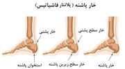 اگر خار پاشنه دارید و از درد آن عاجز شده‌اید، بخوانید