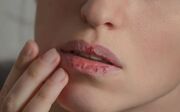 ۱۴ علت رایج خشکی لب و روش های درمان آن