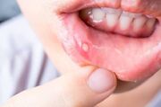 کدام عادات روزانه احتمال بروز سرطان دهان را افزایش می‌دهد؟