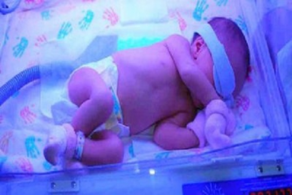 زردی نوزاد و باورهای غلط آسیبزا به کبد کودکان