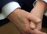 ترامپ استفاده از آسپرین را دلیل کبودی دست خود معرفی کرد