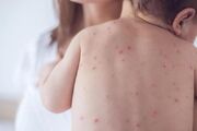  آنچه والدین باید درباره آبله‌مرغان و زونا بدانند