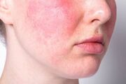 بیماری هزار چهره سیستم ایمنی را بشناسیم