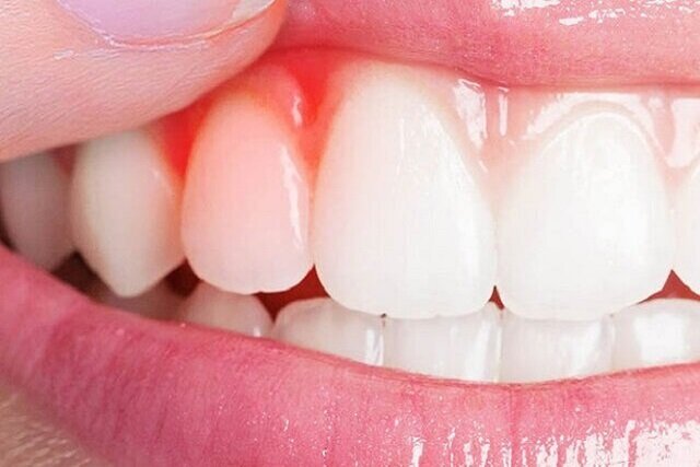 کیفیت پایین خواب، رهاورد بیماریهای لثه