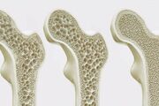 راهنمای جامع پیشگیری و کنترل پوکی استخوان  