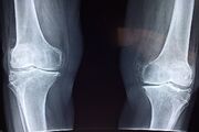 سالمندی جمعیت و چالش جدی سلامت استخوان / مراقبت از سلامت استخوان باید یکپارچه شود
