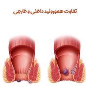 انواع هموروئید داخلی و خارجی + شناخت دقیق و روش‌ درمان