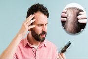 علت ریزش مو چیست؟ + راه های درمان