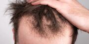 ریزش مو در پاییز را چگونه متوقف کنیم؟ بهترین راهکار‌های پیشگیری و درمان