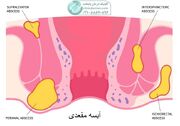 آبسه مقعدی و بهترین راه درمان، نکات و راهکارهای طلایی 