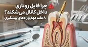 چرا فایل روتاری داخل کانال می‌شکند؟ ۸ علت مهم و راه‌های پیشگیری