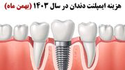 هزینه ایمپلنت دندان در تهران - مردم سالاری آنلاين