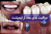 مراقبت‌های بعد از ایمپلنت دندان و معرفی دکتر ایمپلنت در مشهد