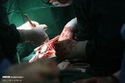تشریح مهم ترین چالش های پیوند ریه در ایران