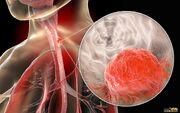 چند نکته مهم درباره سرطان مری