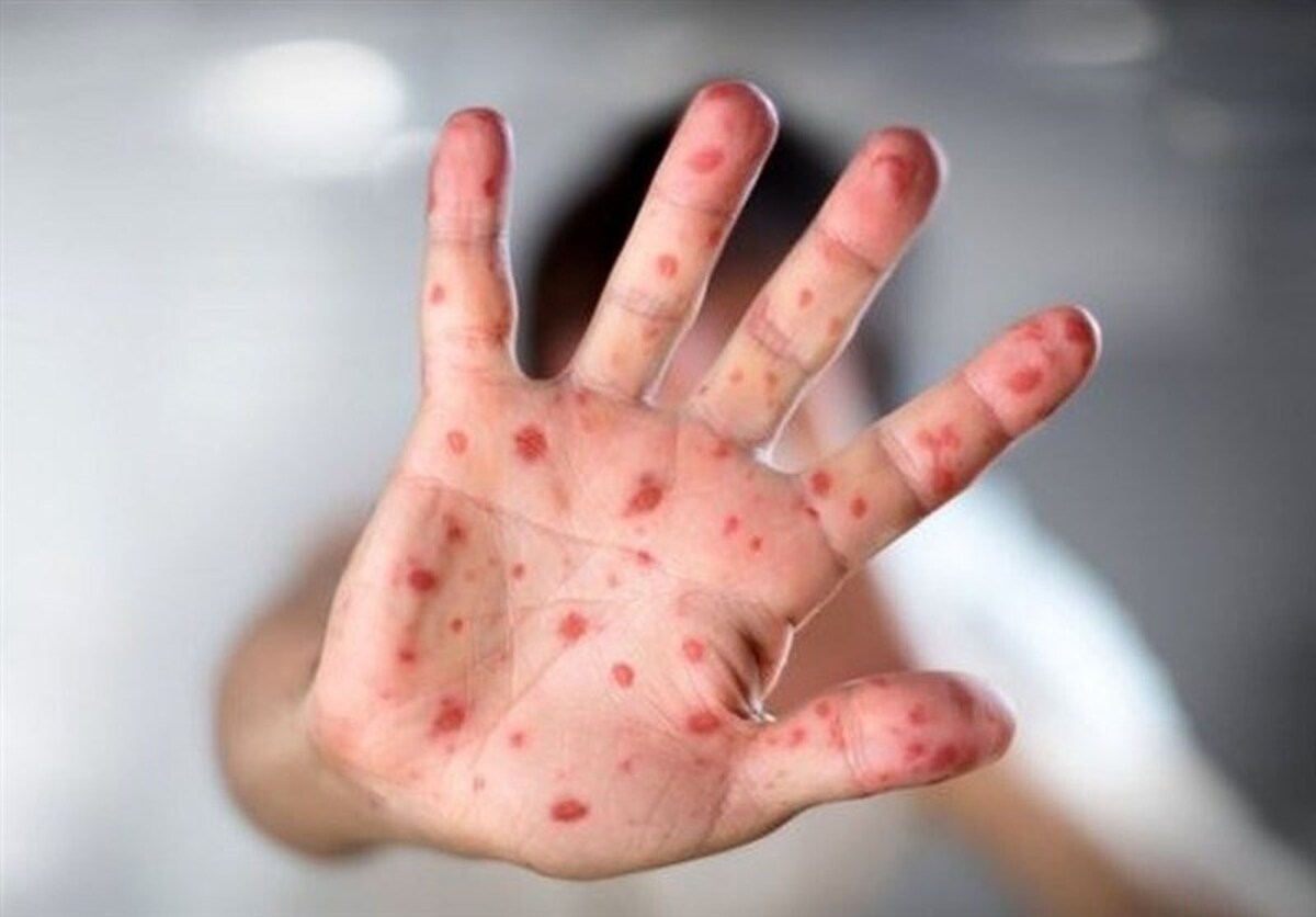 رشد بیسابقه آمار ابتلا به سرخک در آمریکا