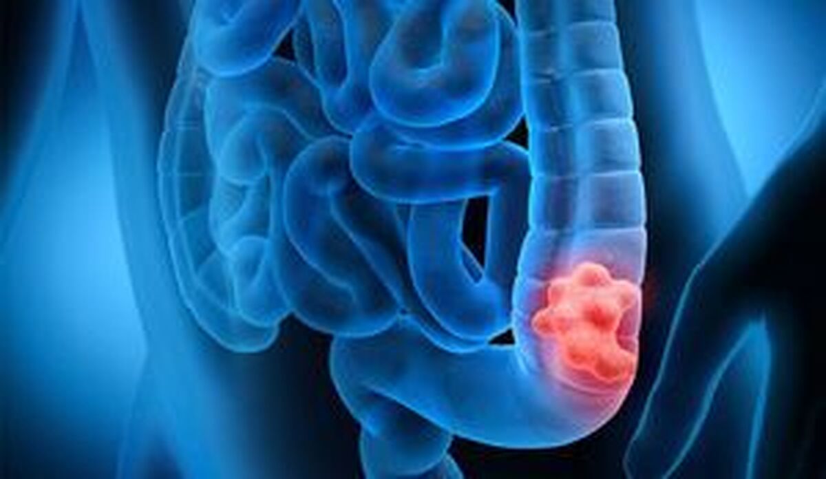 مصرف مشروبات الکلی خطر ابتلا به سرطان روده بزرگ را افزایش میدهد