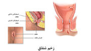 شقاق مقعدی چیست؟ + جدول داروهای گیاهی و شیمیایی برای درمان شقاق مقعدی