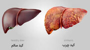 بهترین راه درمان کبد چرب را بشناسید