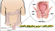 انواع بیماری های مقعدی را بشناسید + روش درمان با جدول