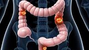 سرطان روده بزرگ: مهم ترین دلایل و پیشگیری