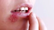 راز عود تبخال در روزهای پرتنش؛ چرا استرس ویروس خفته را بیدار می‌ کند؟