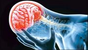 هفدهمین کنگره سکته مغزی در تهران؛ مقابله با مرگ‌ومیر ۱۰۰ هزار بیمار سالانه