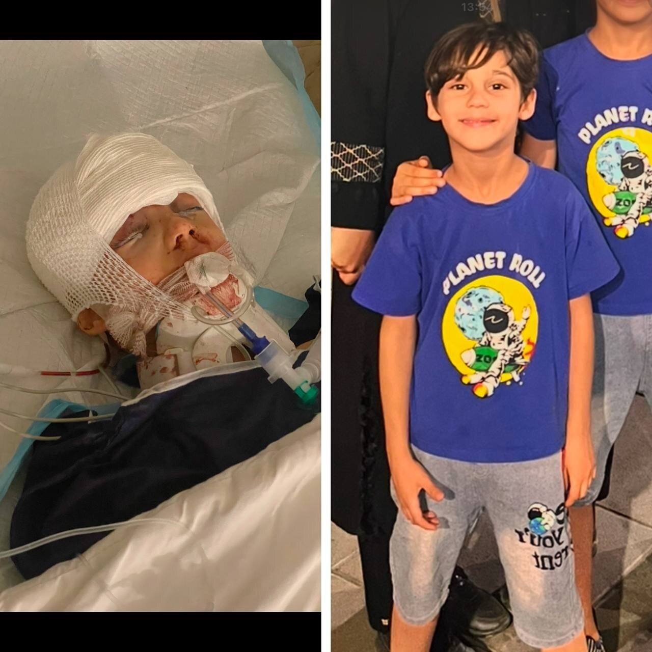 تصویر تکان‌دهنده پسر کوچک سقاب اصفهانی پس از چند عمل مغز هنوز در اغما