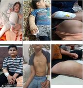 پشت پرده وضعیت ناگوار بیماران هموفیلی