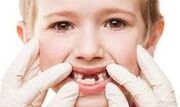 چرا دندان کودک در مواجهه با دود سیگار آسیب می‌بیند؟
