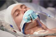 تغییر باکتری‌های روده پس از ضربه به سر