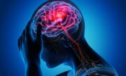 بازیابی قدرت بازو پس از سکته مغزی با تحریک نخاع