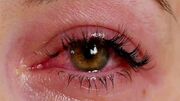 عوارض پنهان اکستنشن مژه در سلامت چشم