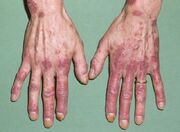 لوپوس؛ بیماری که در کمین کودکان نشسته!