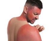 خطرات تنها یک بار آفتاب‌سوختگی شدید برای سلامت