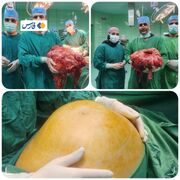 نبرد نفس‌گیر تیم جراحی ارتش با تومور ۲۰ کیلویی