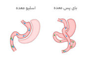 مقایسه اسلیو معده و بای پس معده